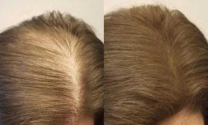 Восстановление роста волос